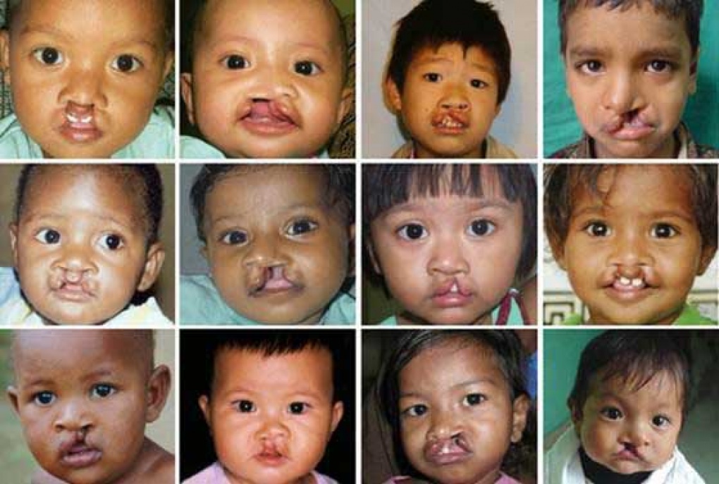 Заячья губа и волчья пасть. Смола из расщелин 5. Смола хвойных деревьев. Правосторонняя расщелина губы и неба. Смола живица.